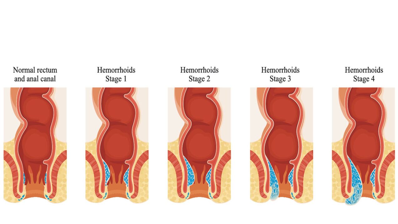 tipos de hemorróidas